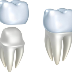 Dental Crowns