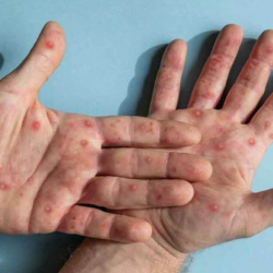 Monkeypox
