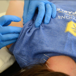 Dry Needling