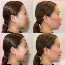 Dermal Fillers