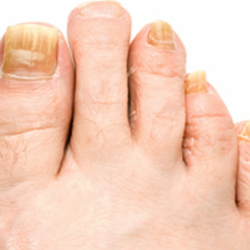 Fungus Toenails