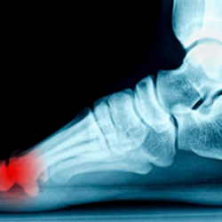 Morton's Neuroma
