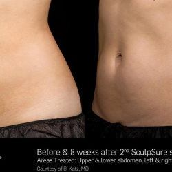 SculpSure Laser Body Contouring