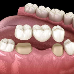 Dental Bridges