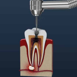 Root Canal Treatment