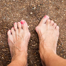 Bunions / Lapiplasty