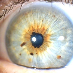 Iridology
