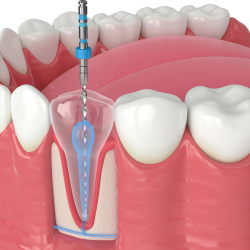 Root Canal Therapy