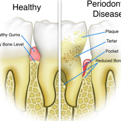 Periodontal Treatment