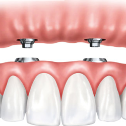 Implant Supported Dentures