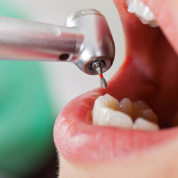 Dental Cleaning