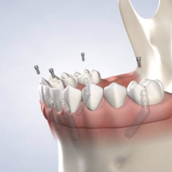 Full-Arch Restoration