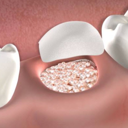 Bone Grafting