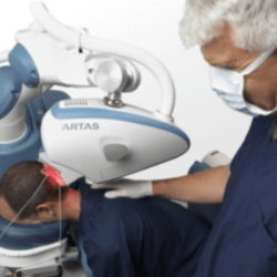 ARTAS Hair Transplantation