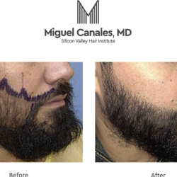 Beard Transplant