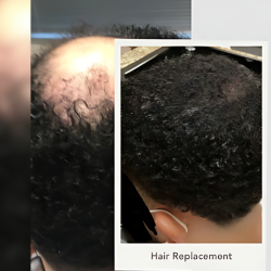 Non-surgical Hair Replacement