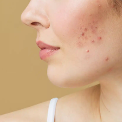 Acne Treatment
