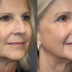 Microneedling with/without PRP (Platelet-Rich Plasma)