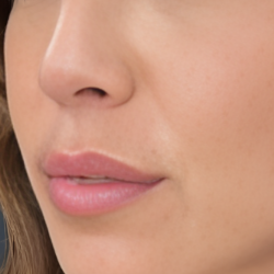 Filler Injections