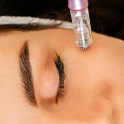 Scarlet RF Microneedling