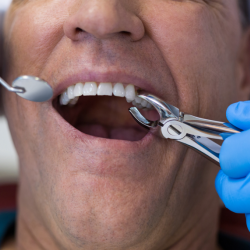 Tooth Extraction