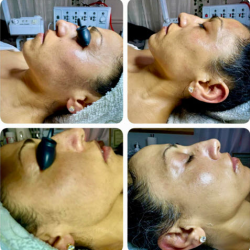 Dermaplaning Facial