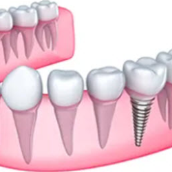 Dental Implants