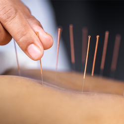 Acupuncture