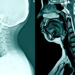 Degenerative Disc, Bulging 