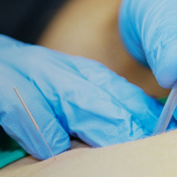 Dry Needling Physical Therapy