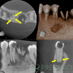 Root Canal Retreatment