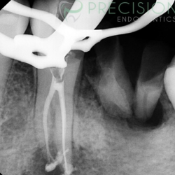 Root-End Surgery/Apicoectomy