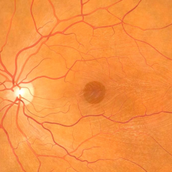 Macular Hole Treatment 