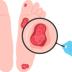 Critical Limb Ischemia Management