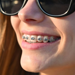 Metal Braces