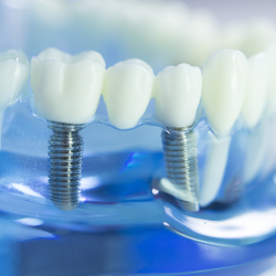 Dental Implants 