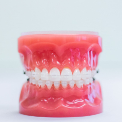 Clear Braces 