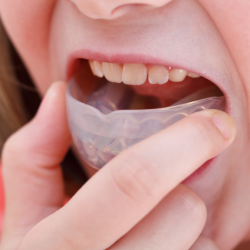 Mouthguards for Braces