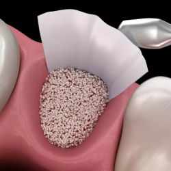 Bone Grafting