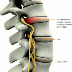 Trigger Point Injections