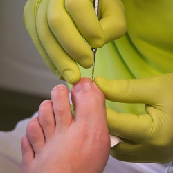 Ingrown Toenails