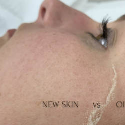 Chemical Peel Care