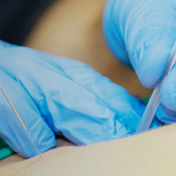 Dry Needling Physical Therapy