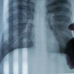 Asbestos Related Lung Cancer