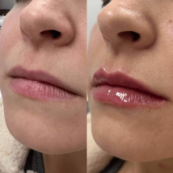 Dermal Fillers