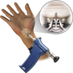 SMARTRELEASE Endoscopic Carpal Tunnel Release System