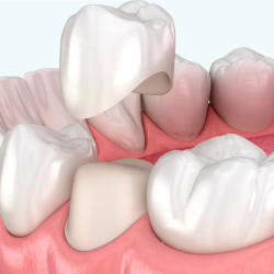 Dental Crowns