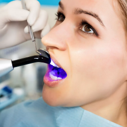 Dental Sealants