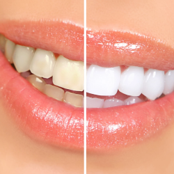 Teeth Whitening