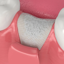 Bone Graft 